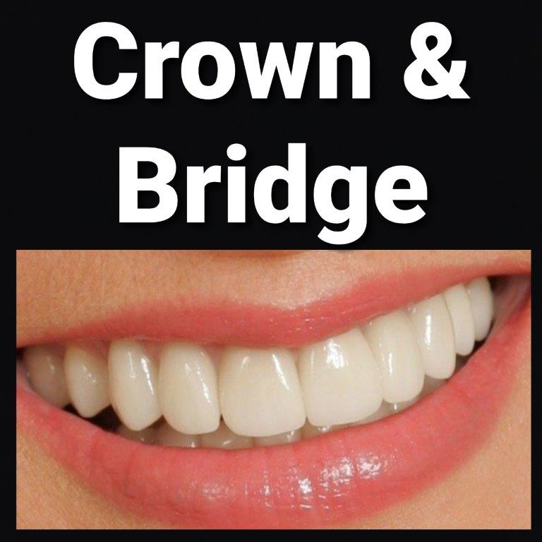 crowns & bridges
